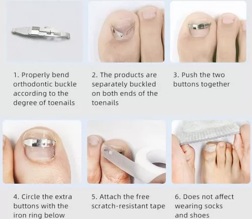 merkloos Ingrown Toenail Corrector 2PCS Stainless Steel Paronychia Correction Tool (8785306004007)