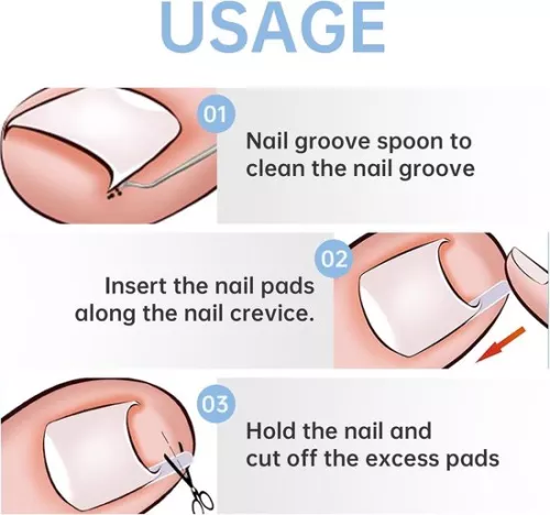 merkloos 40 pieces of ingrown toenail smoothing strips with toenail lifter for correction of ingrown toenails (9509465873675)