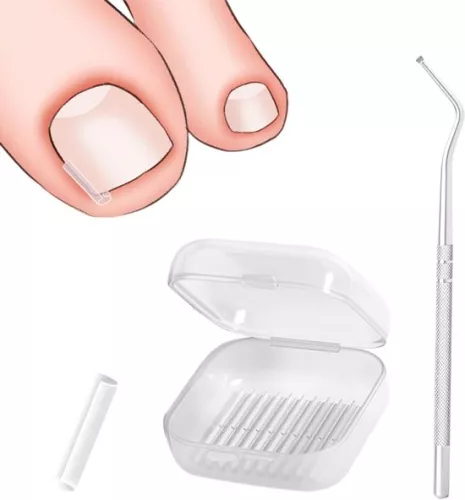 merkloos 40 pieces of ingrown toenail smoothing strips with toenail lifter for correction of ingrown toenails (9509465873675)