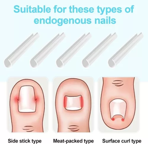 merkloos Ingrown Toenail Correction Kit - 40 Pieces Painless Toenail Smoothing Strips with Toenail Lifter (8785322238837)