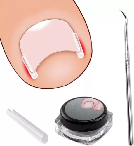 merkloos Ingrown Toenail Correction Kit - 40 Pieces Painless Toenail Smoothing Strips with Toenail Lifter (8785322238837)